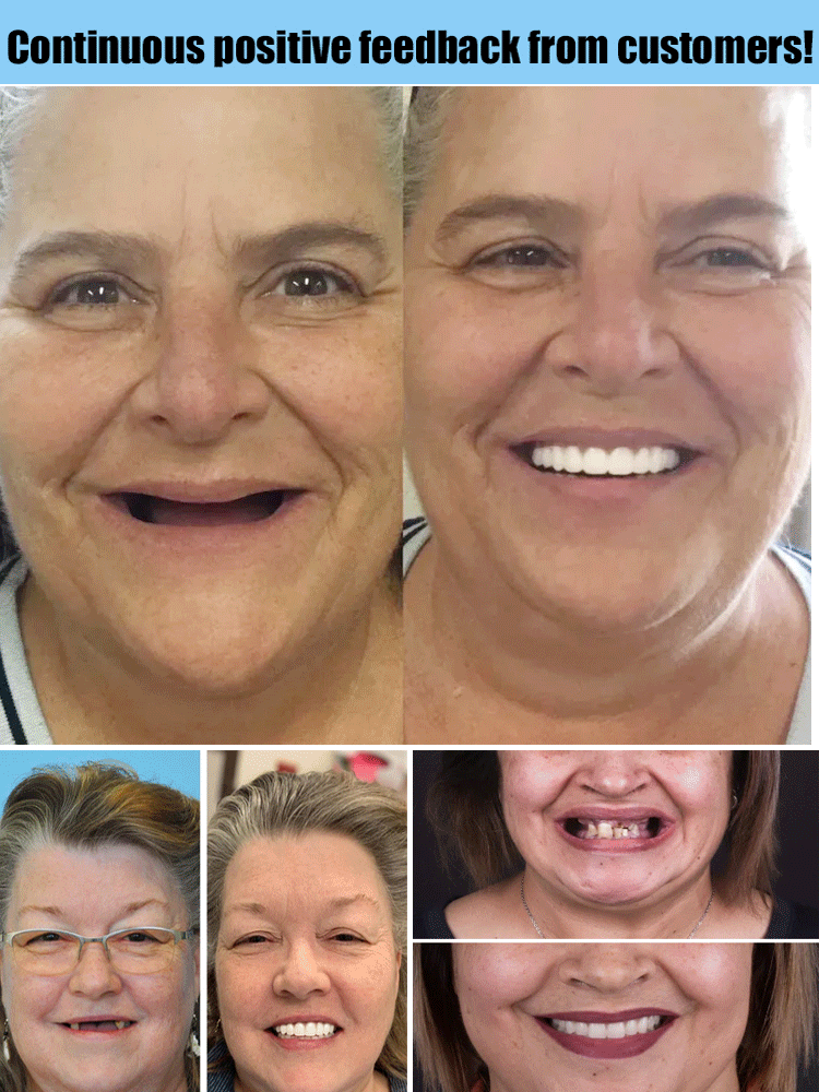 Flexible Denture Set for Upper and Lower Jaw – Reusable and Custom-Fit