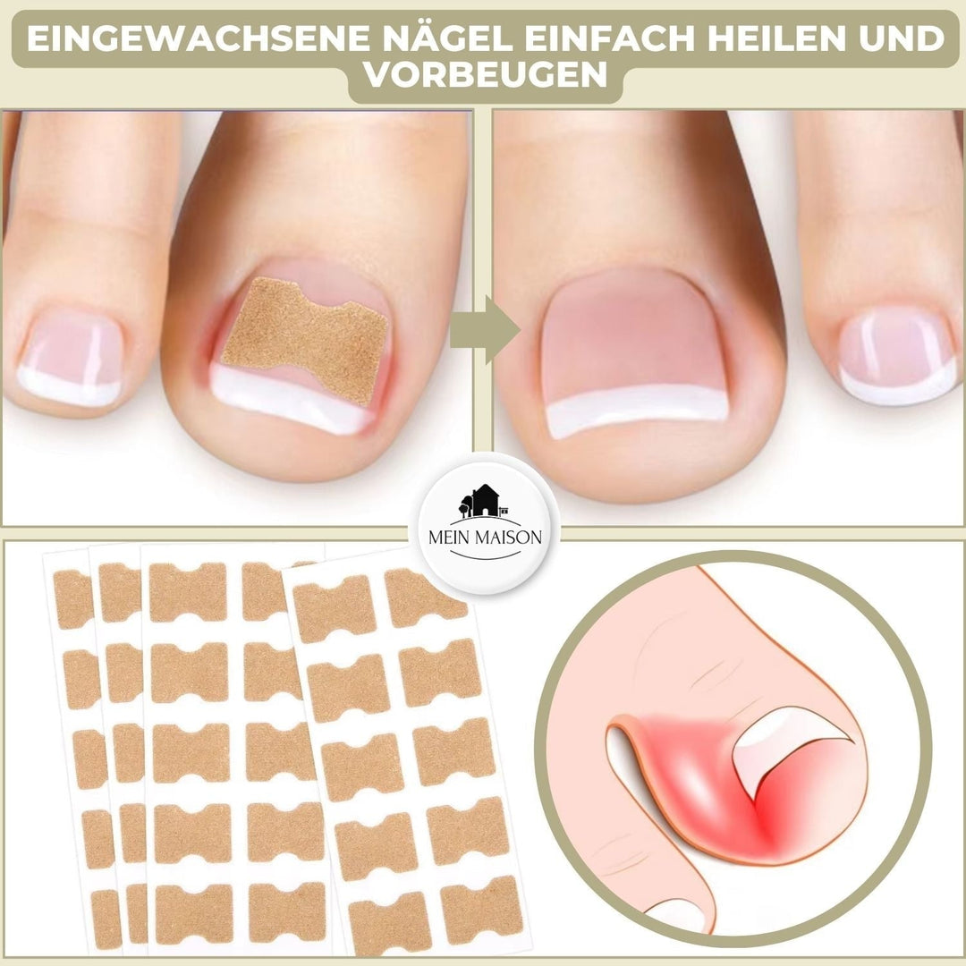 Ingrown Toenail Patches with Adhesive Backing for Nail Straightening 20 Count