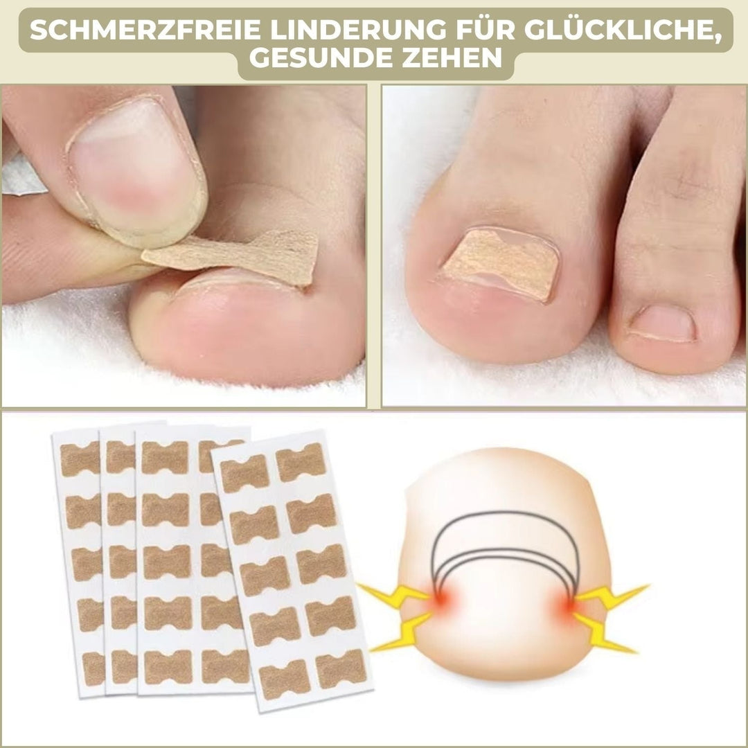 Ingrown Toenail Patches with Adhesive Backing for Nail Straightening 20 Count