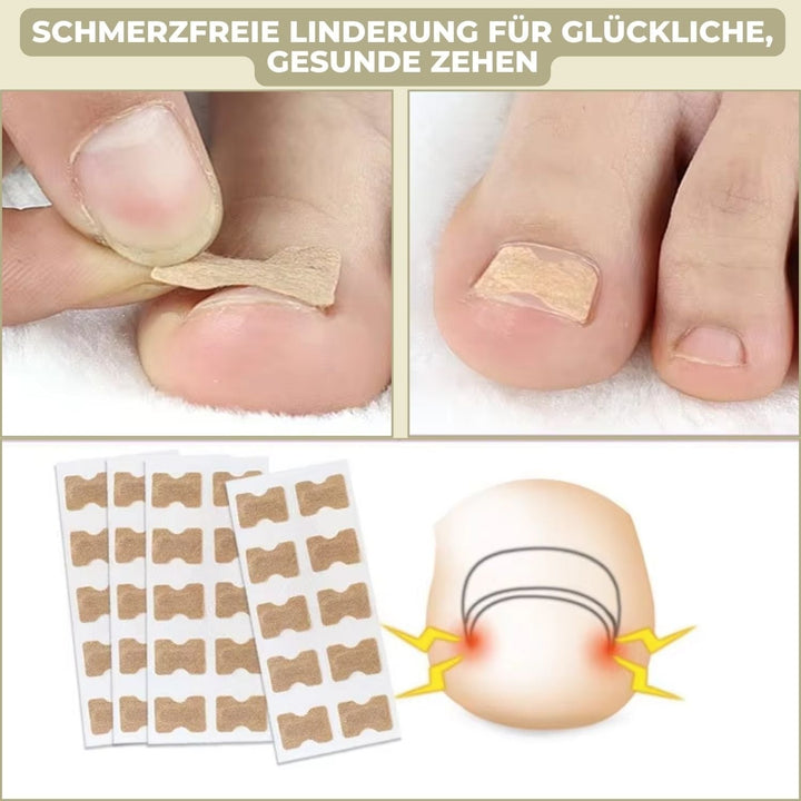 Ingrown Toenail Patches with Adhesive Backing for Nail Straightening 20 Count