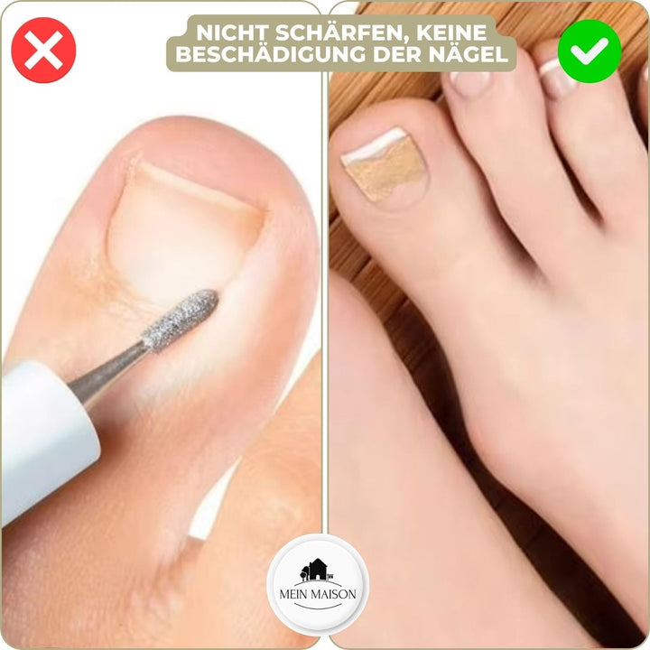 Ingrown Toenail Patches with Adhesive Backing for Nail Straightening 20 Count